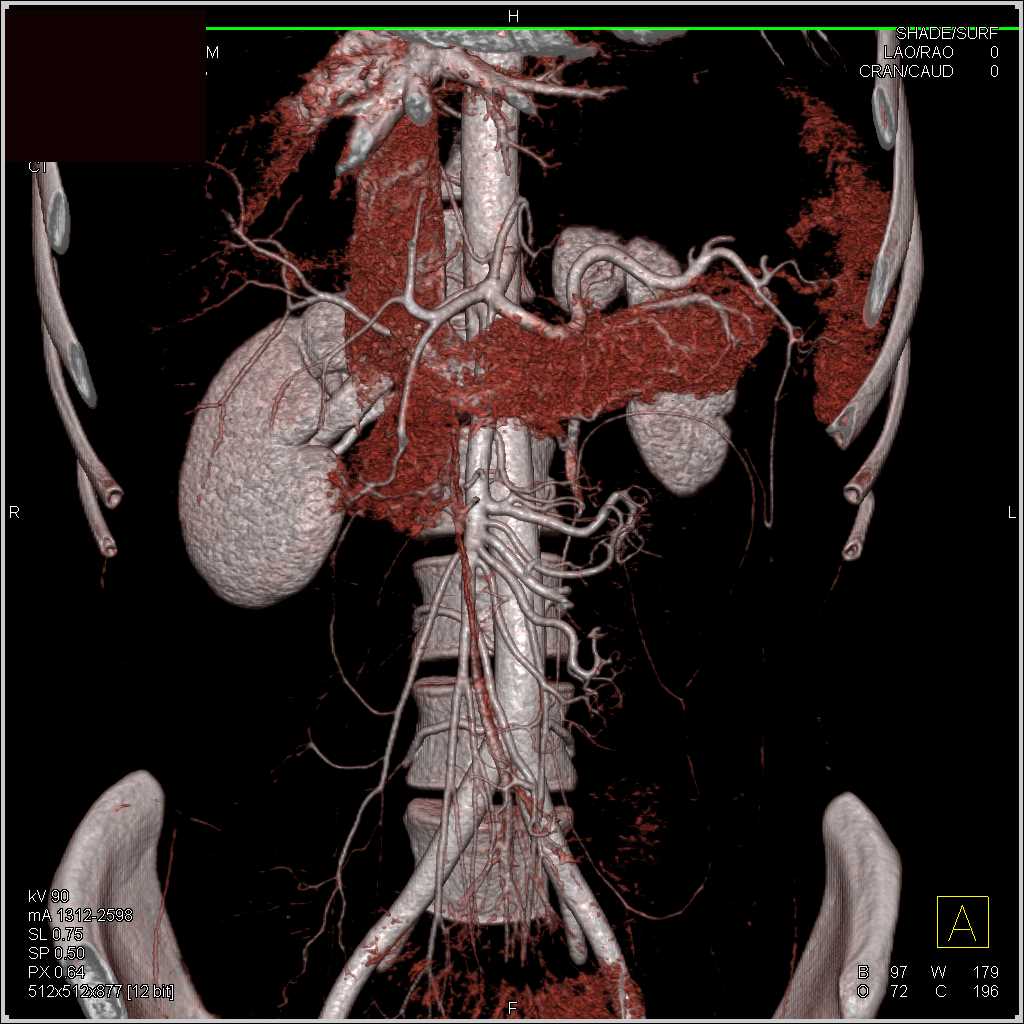 3D Mapping of the Pancreas and Mesenteric Arteries - CTisus CT Scan