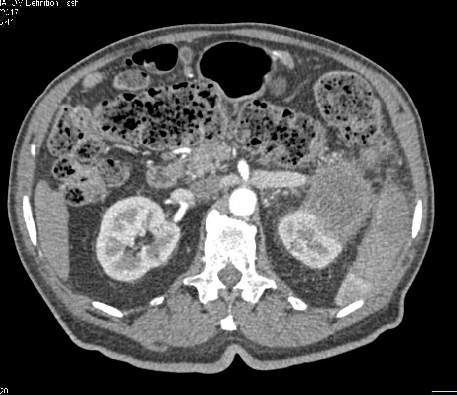 Carcinoma Tail of the Pancreas with Involvement of the Left Kidney - CTisus CT Scan