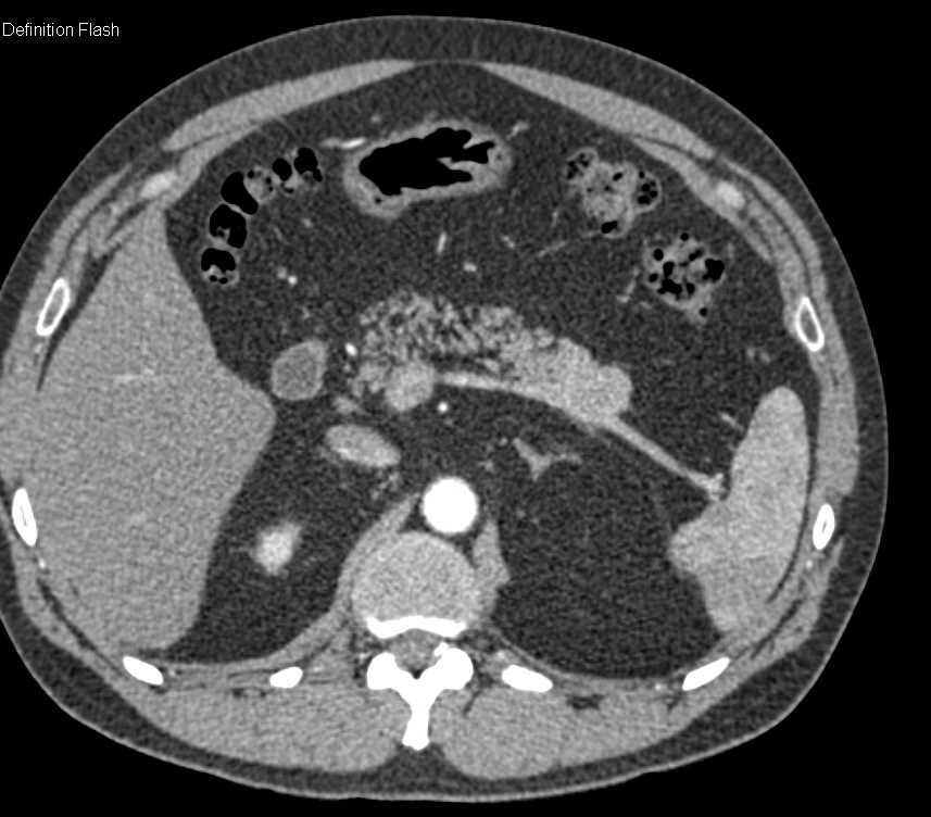 Neuroendocrine Tumor in the Tail of the Pancreas - CTisus CT Scan