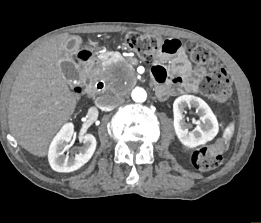 Carcinoma Head of Pancreas with Stent in Common Bile Duct - CTisus CT Scan