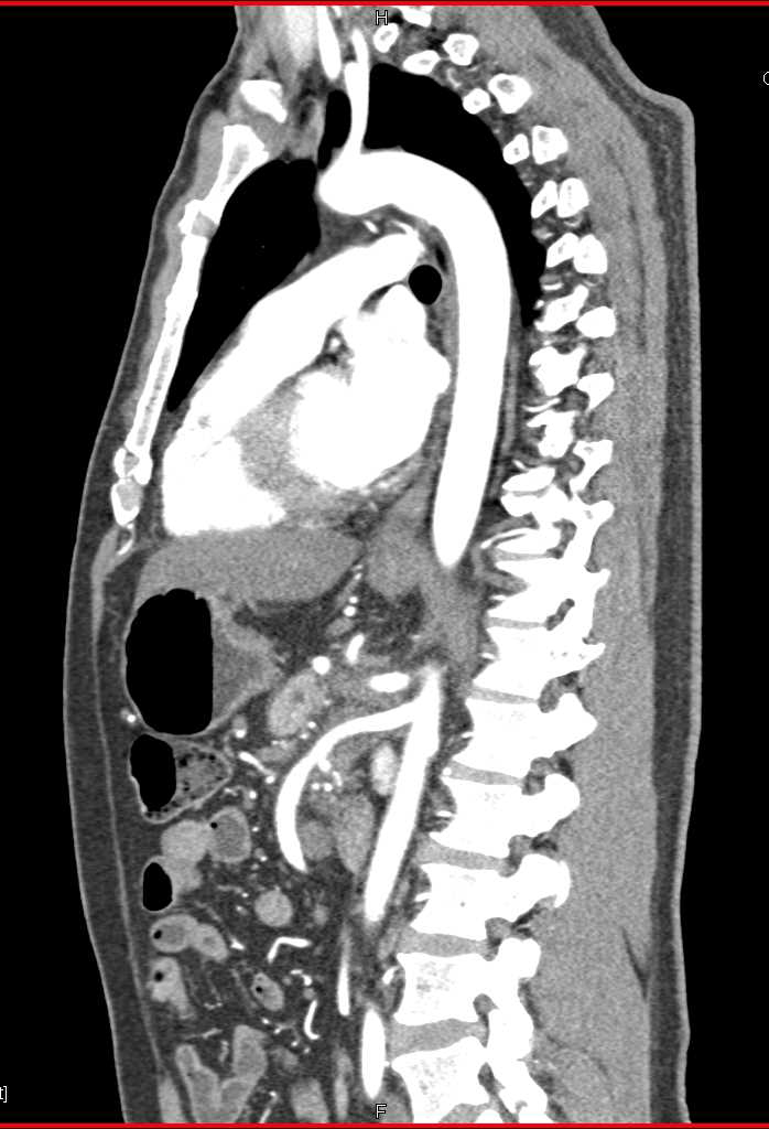 Pancreas Cancer with Vessel Encasement - CTisus CT Scan