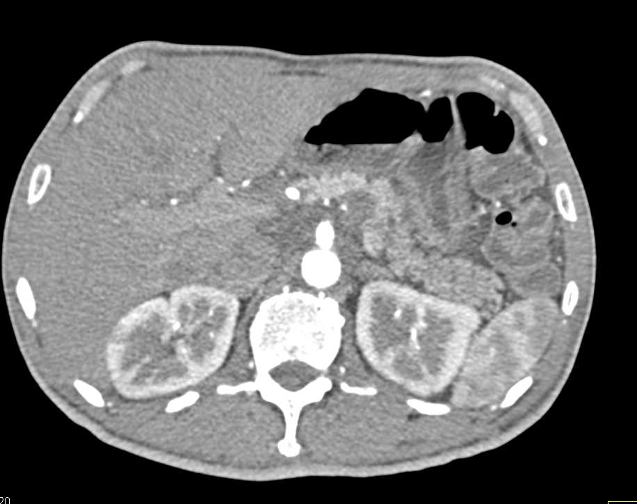 IPMN Body of the Pancreas - CTisus CT Scan