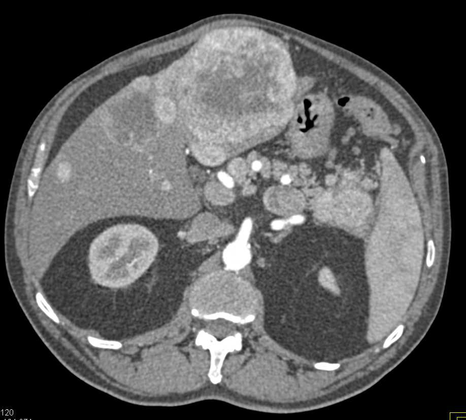 Pancreatic Neuroendocrine Tumor (PNET) Tail of the Pancreas with Liver Metastases - CTisus CT Scan