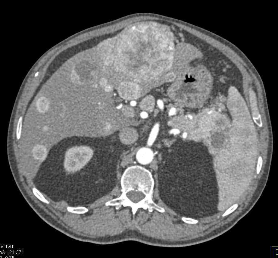 Pancreatic Neuroendocrine Tumor (PNET) Tail of the Pancreas with Liver Metastases - CTisus CT Scan