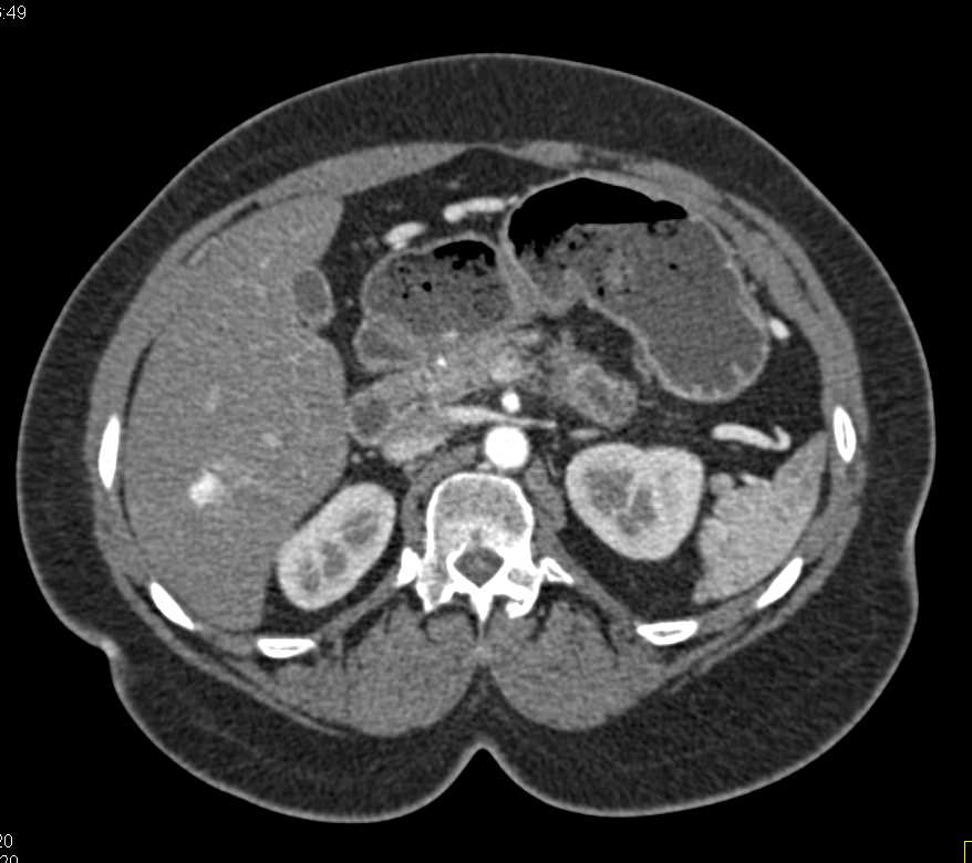 Pancreatic Cancer and Hemangioma Liver - CTisus CT Scan