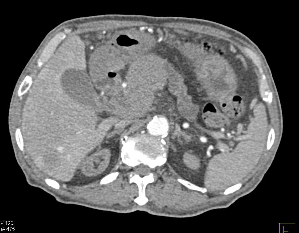 Lymphoma involves the Pancreas Head - CTisus CT Scan