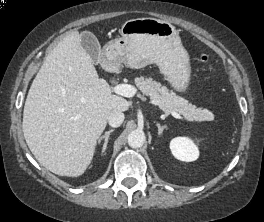 Intraductal Papillary Mucinous Neoplasm (IPMN) Head of Pancreas - CTisus CT Scan