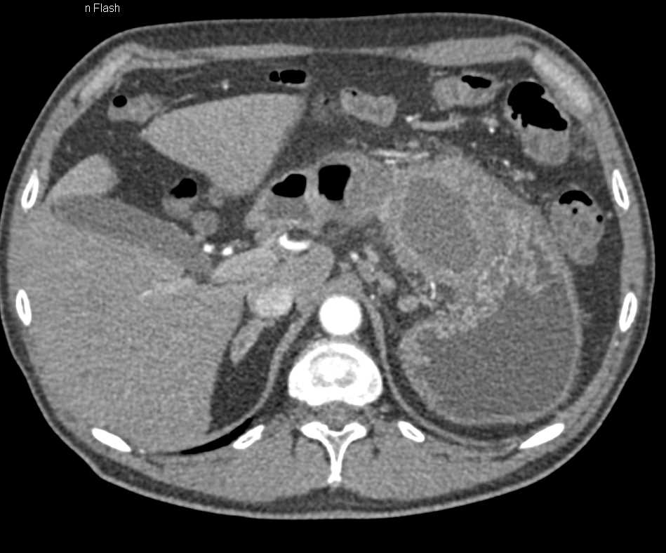 Pseudocyst Tail of Pancreas s/p Distal Pancreatectomy and Splenectomy - CTisus CT Scan