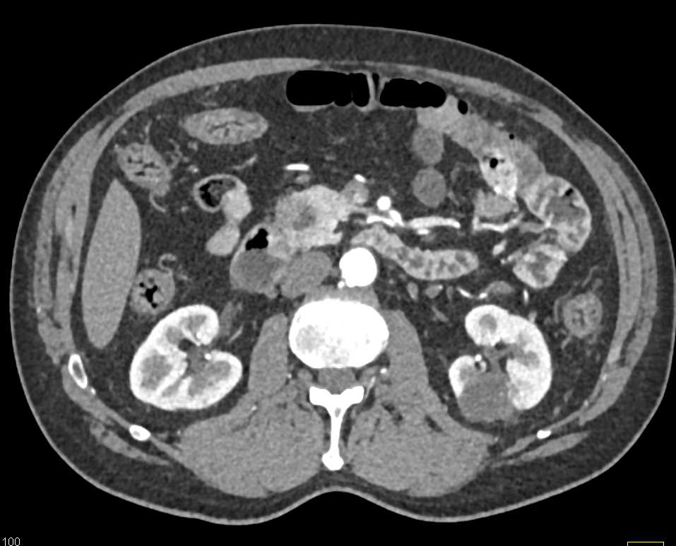 Adenocarcinoma of the Pancreas - CTisus CT Scan