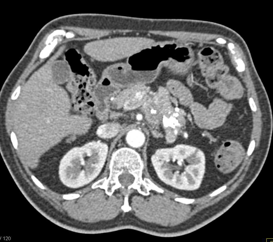 Neuroendocrine Tumor of the Pancreas with Calcifications in the Tumor - CTisus CT Scan