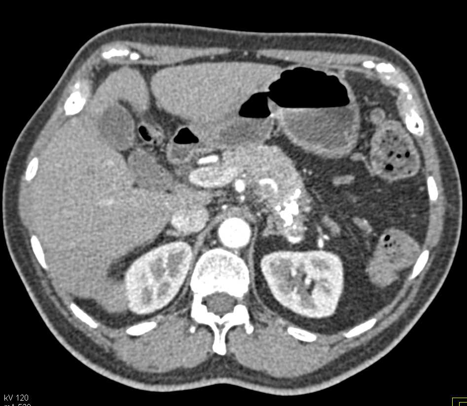 Neuroendocrine Tumor of the Pancreas with Calcifications in the Tumor - CTisus CT Scan