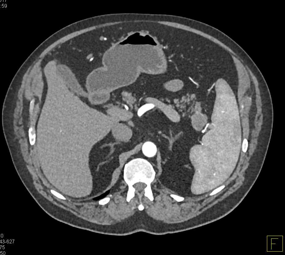 Carcinoma Tail of the Pancreas - CTisus CT Scan