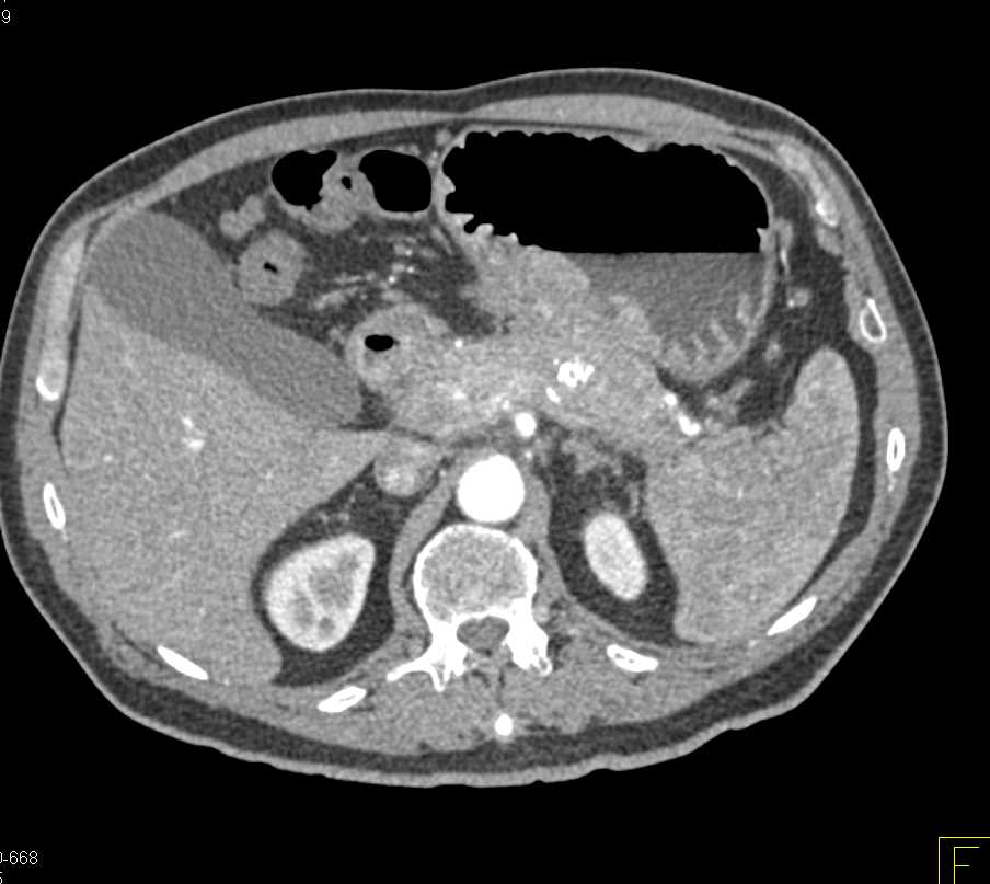 Neuroendocrine Tumor in the Tail of the Pancreas - CTisus CT Scan