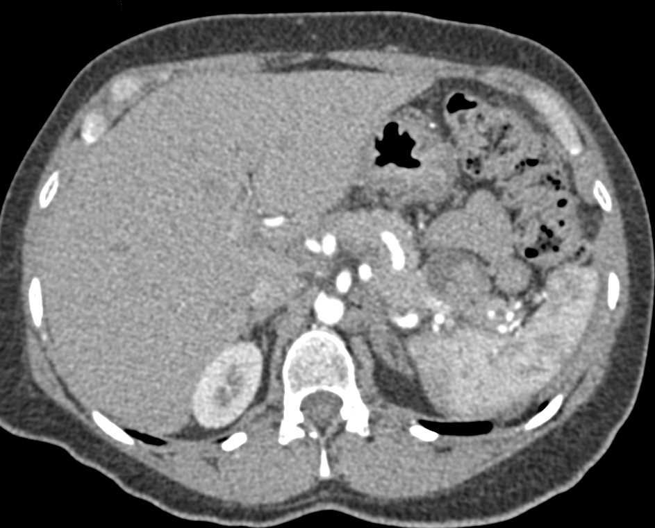 Solid and Papillary Epithelial Neoplasm (SPEN) Tail of Pancreas - CTisus CT Scan