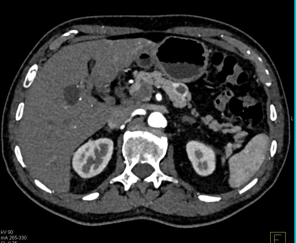 Cystic Neuroendocrine Tumor Body of the Pancreas - CTisus CT Scan