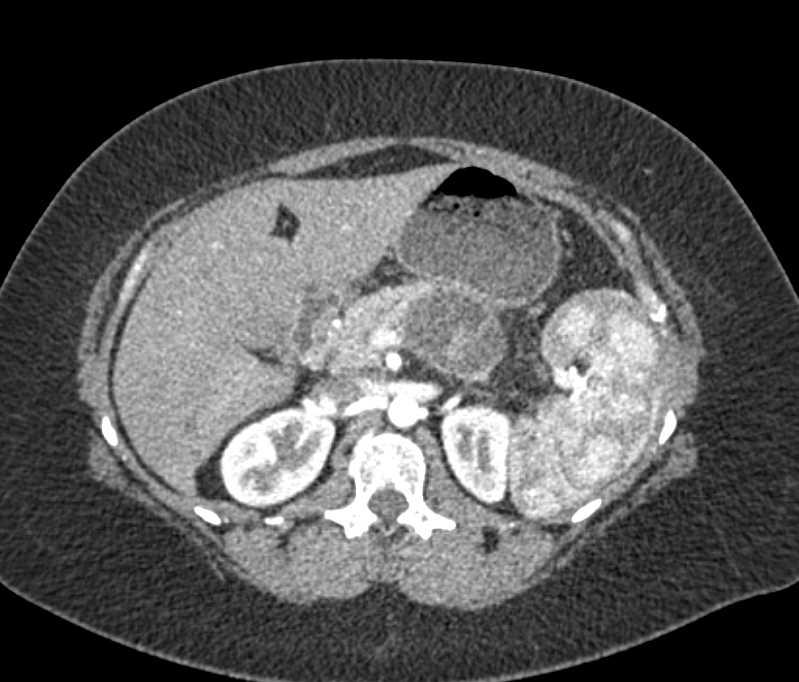 Mucinous Cystic Neoplasm (MCN) Tumor Body of the Pancreas - CTisus CT Scan