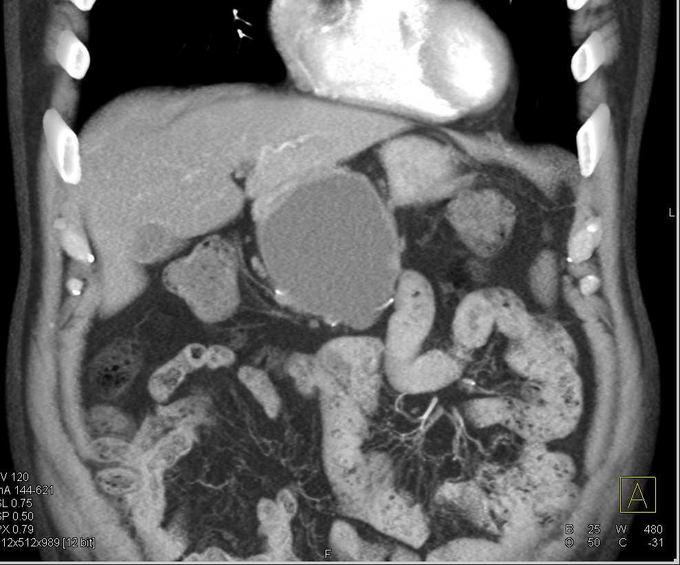 Mucinous Cystic Neoplasm (MCN) Body of the Pancreas - CTisus CT Scan