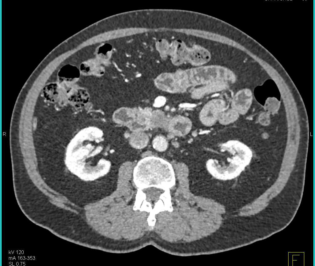 Pancreatic Cancer Involves the Duodenum - CTisus CT Scan