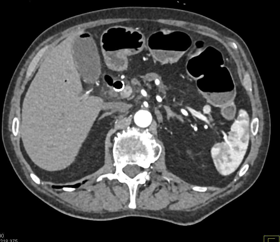 Stent in Common Bile Duct (CBD) with Pancreatic Cancer - CTisus CT Scan