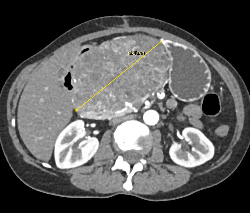 Cystadenocarcinoma of the Pancreas - CTisus CT Scan