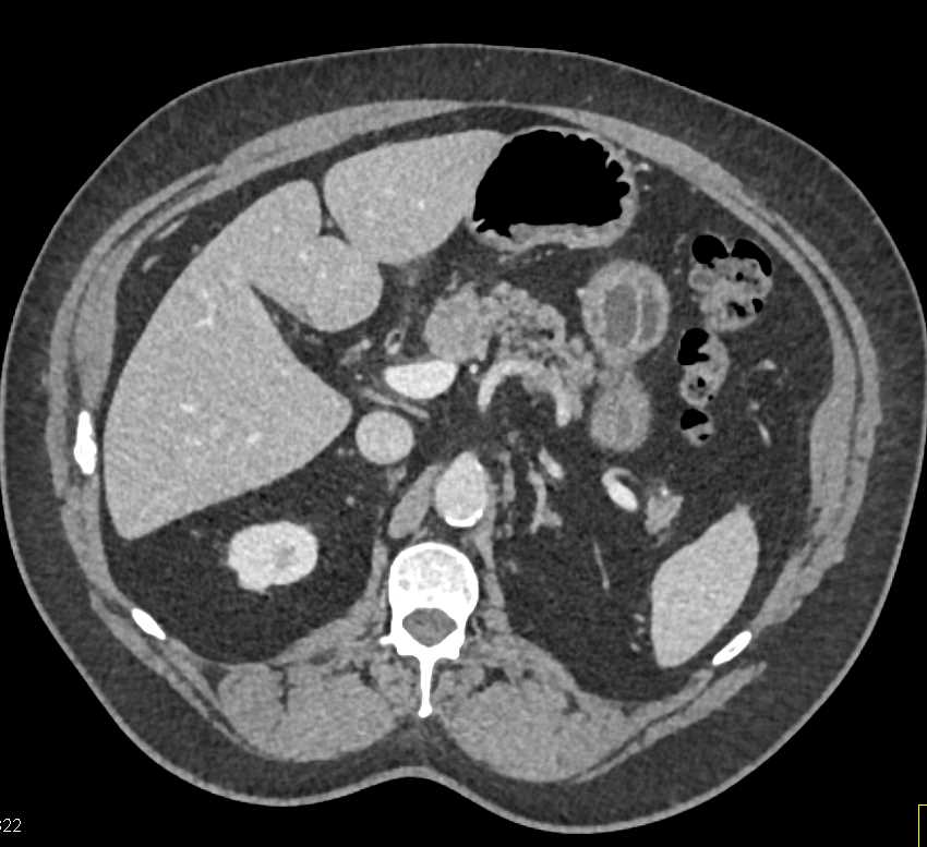 Pancreatic Cancer - CTisus CT Scan