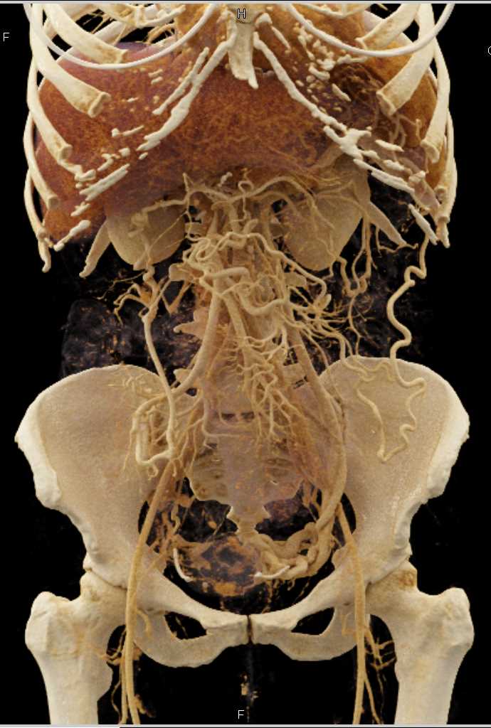 Pancreatic Cancer with Vascular Encasement PV/SMV with Cinematic Rendering - CTisus CT Scan