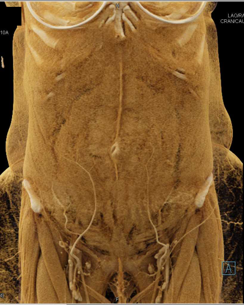 Pancreatic Cancer with Vascular Encasement with Cinematic Rendering - CTisus CT Scan