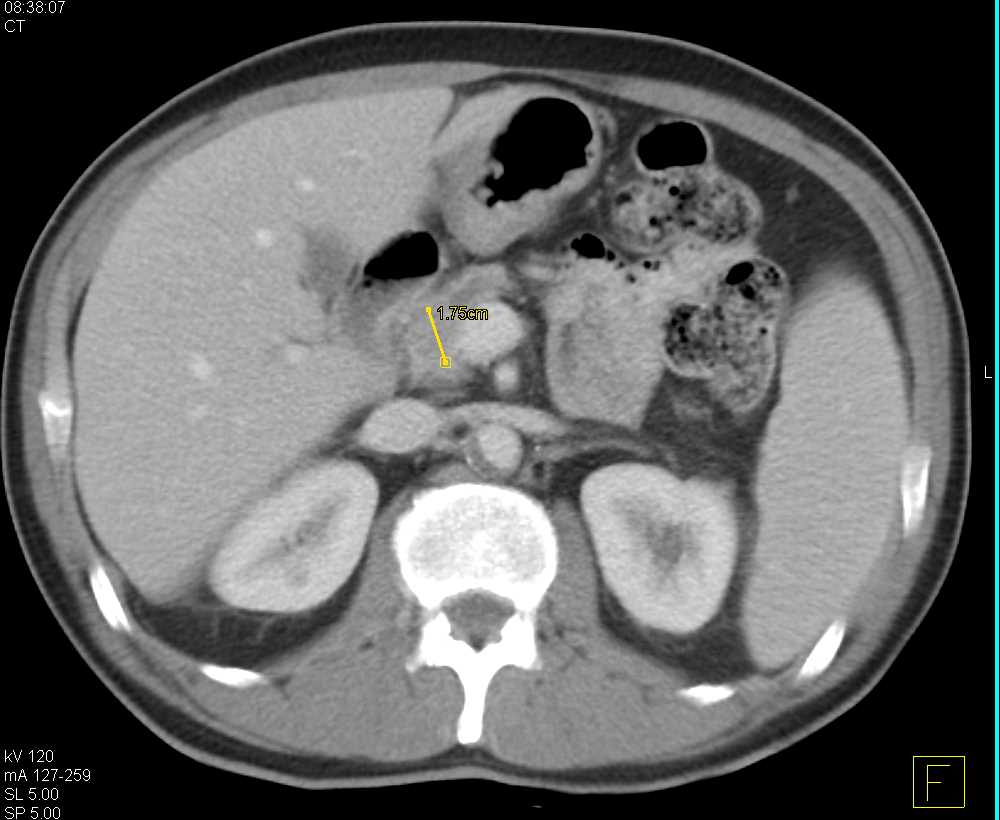 Carcinoma Head of Pancreas - CTisus CT Scan