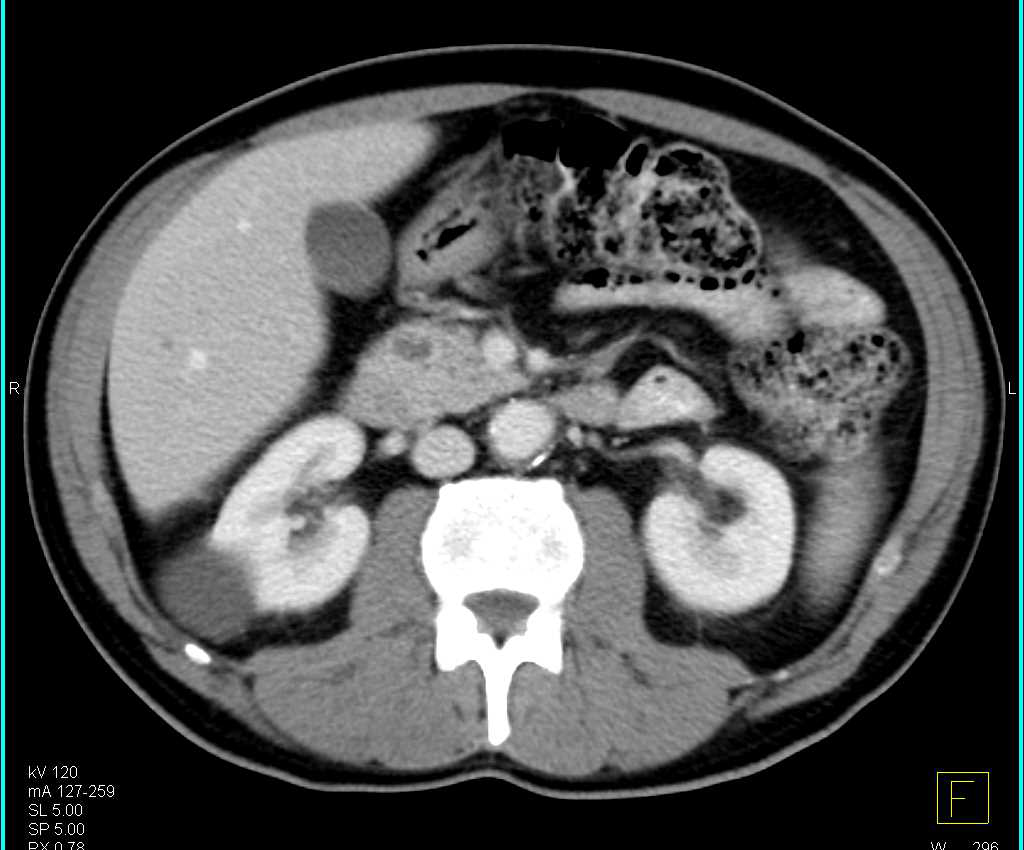 Carcinoma Head of Pancreas - CTisus CT Scan