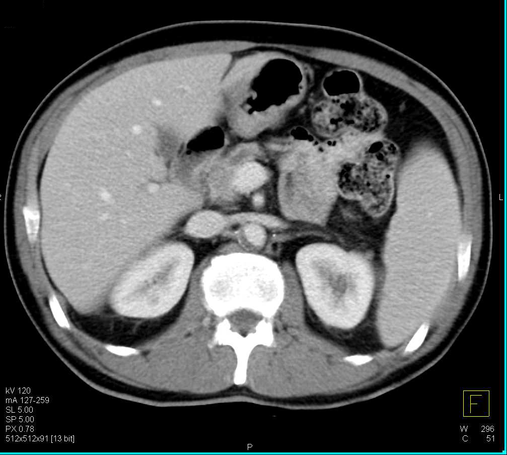 Subtle Carcinoma Head of Pancreas with Dilated Pancreatic Duct - CTisus CT Scan