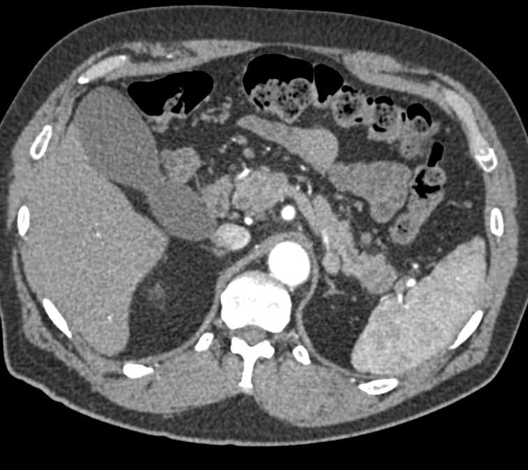 Carcinoma Tail of Pancreas is Subtle - CTisus CT Scan