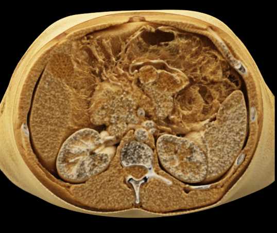 Carcinoma Pancreas with Vascular Encasement with Cinematic Rendering - CTisus CT Scan