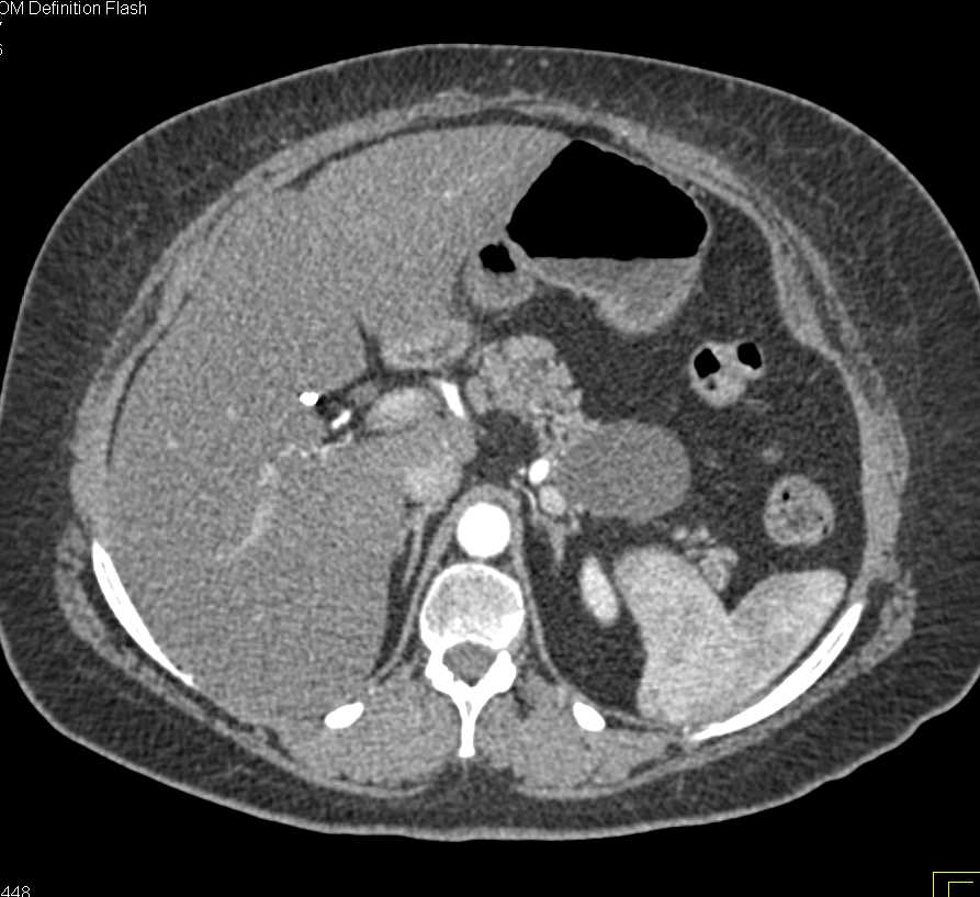 Mucinous Cystic Lesion of the Pancreas - CTisus CT Scan