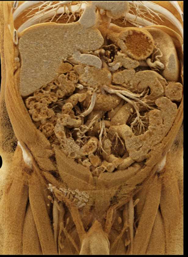 Pancreatic Cancer with Cinematic Rendering - CTisus CT Scan