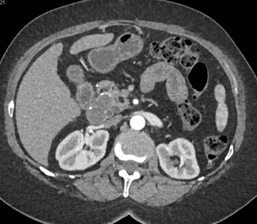 Serous Cystadenoma Head of Pancreas - CTisus CT Scan