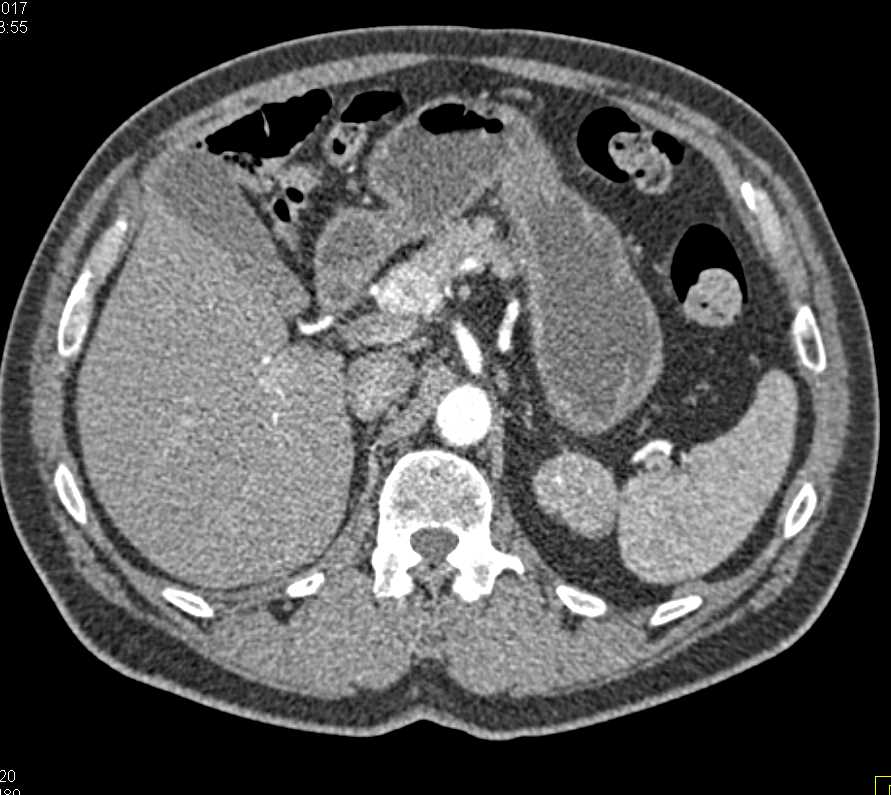 Neuroendocrine Tumor in the Head of the Pancreas and Pheochromocytoma Left Adrenal - CTisus CT Scan