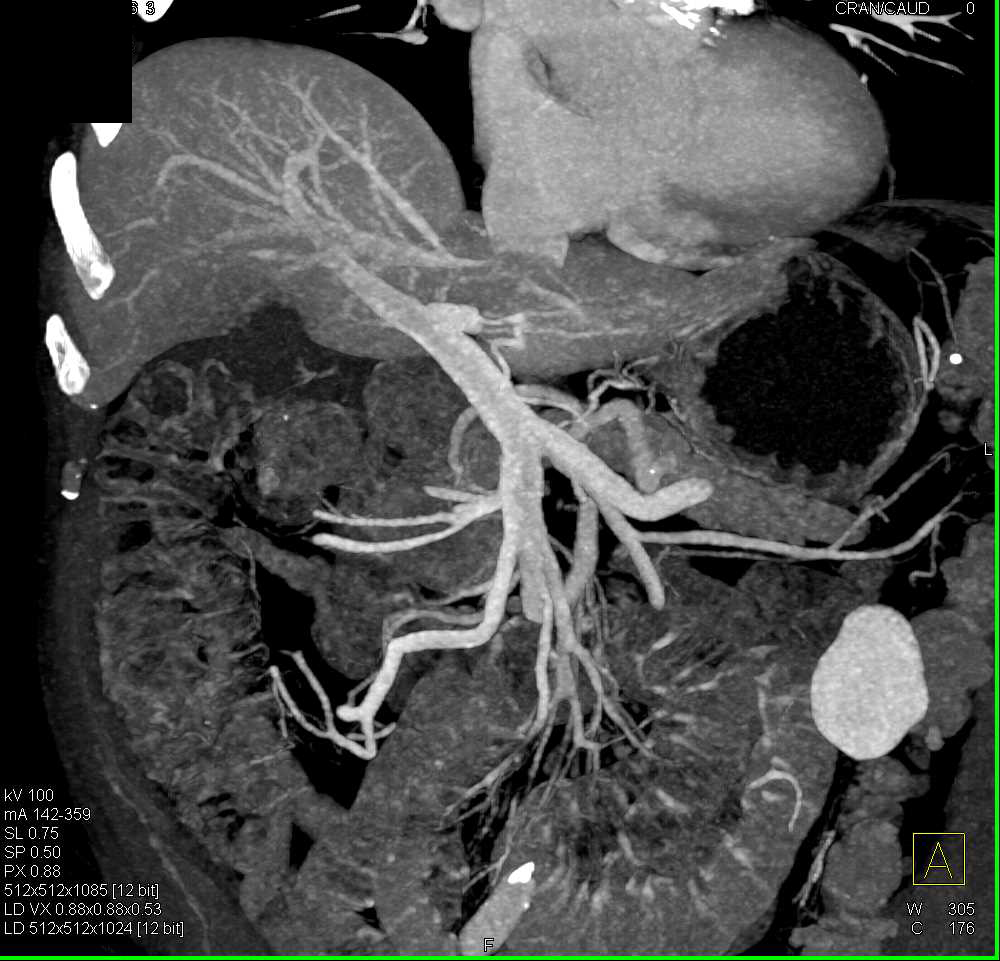 Pancreas Adenocarcinoma - CTisus CT Scan