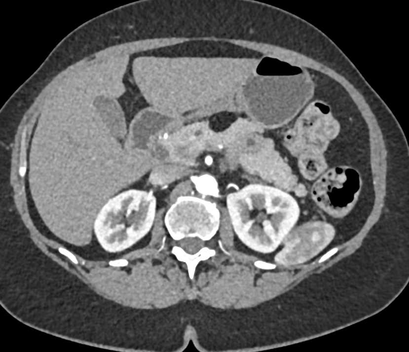 Lipoma of the pancreas - CTisus CT Scan