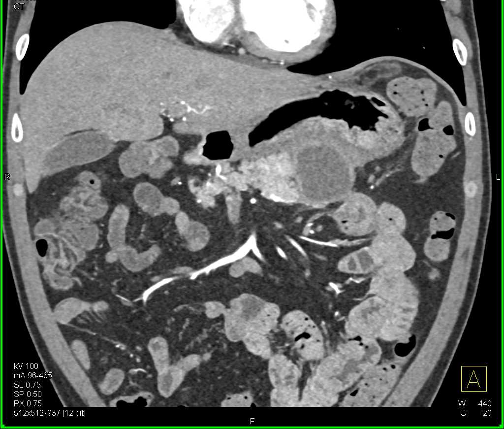 Mucinous Cystic Neoplasm Tail of Pancreas - CTisus CT Scan