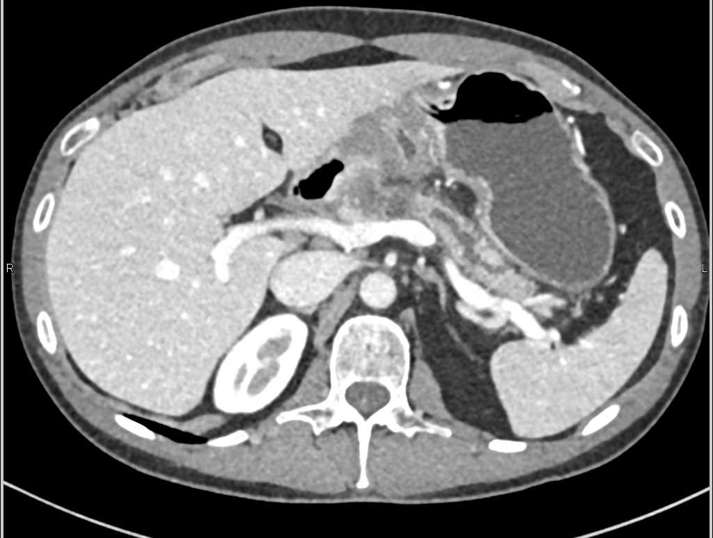 Carcinoma Body of Pancreas with Dilated Pancreatic Duct - CTisus CT Scan