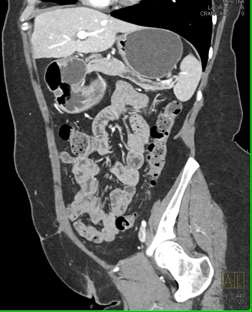 Subtle Carcinoma Body of Pancreas with Dilated Pancreatic Duct - CTisus CT Scan