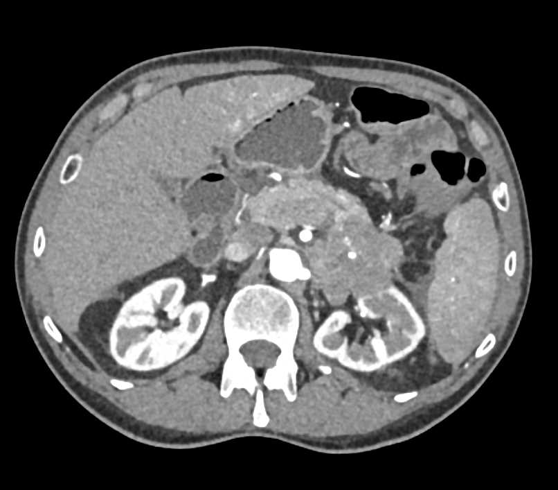 Carcinoma Tail of Pancreas Invades the Left Kidney - CTisus CT Scan