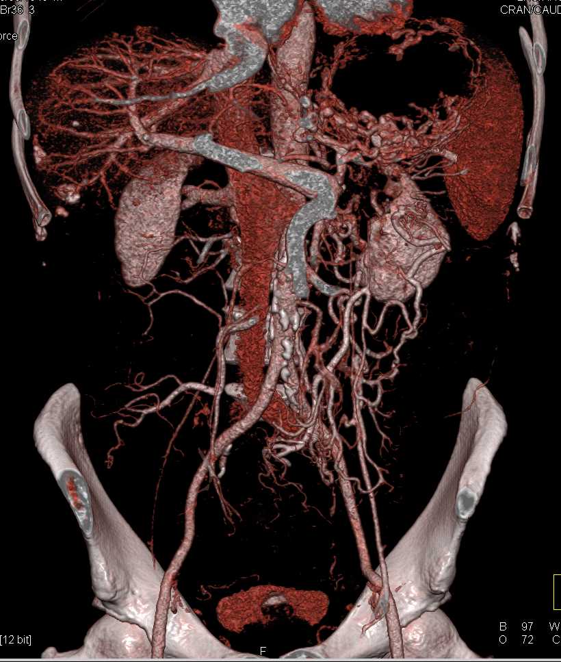 Carcinoma Tail of Pancreas Invades the Left Kidney - CTisus CT Scan