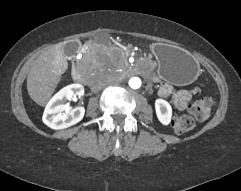 Pancreatic Adenocarcinoma - CTisus CT Scan