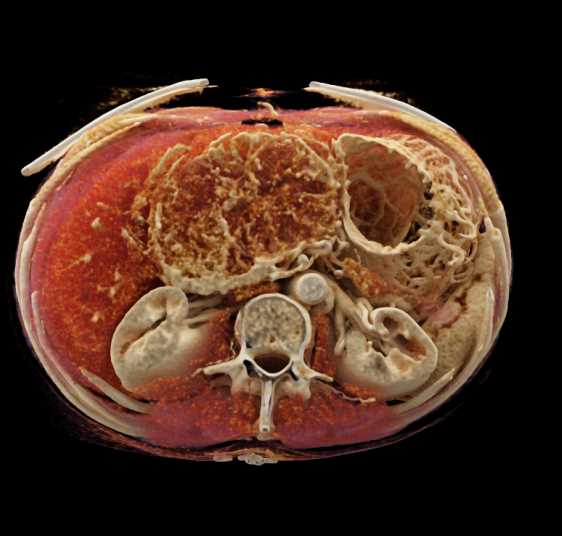 Serous Cystadenoma Head of Pancreas with Cinematic Rendering - CTisus CT Scan