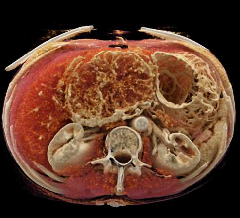 Serous Cystadenoma Head of Pancreas with Cinematic Rendering - CTisus CT Scan