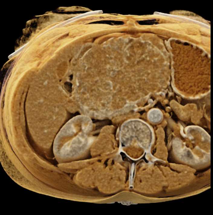 Serous Cystadenoma Head of Pancreas - CTisus CT Scan