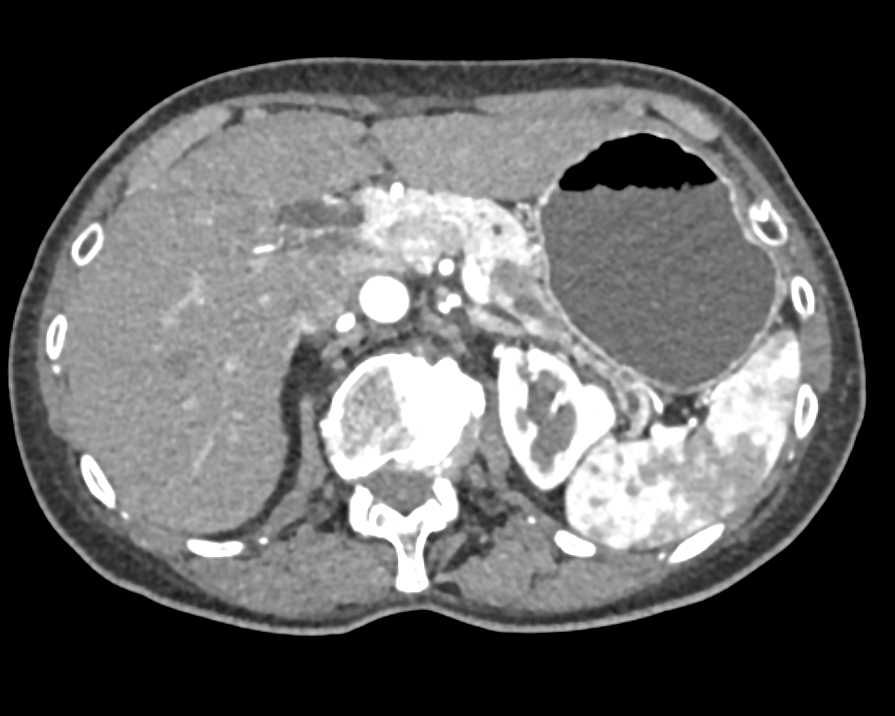 Adenocarcinoma Obstructs the Pancreatic Duct - CTisus CT Scan