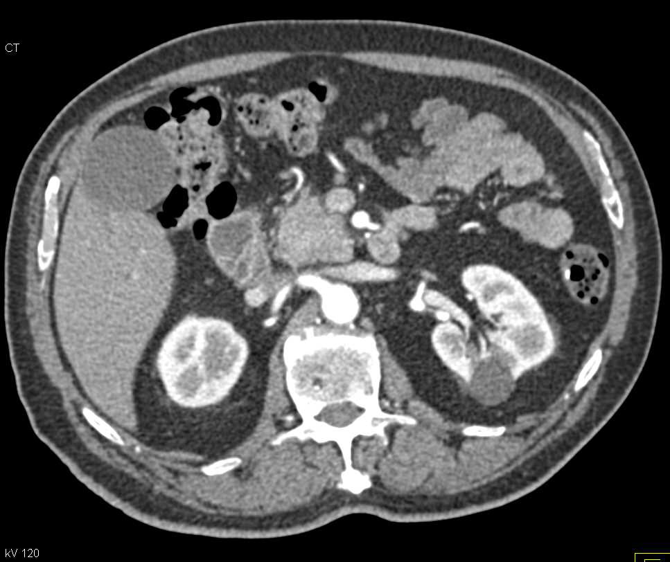 Pancreatic Cancer of the Head of the Pancreas - CTisus CT Scan