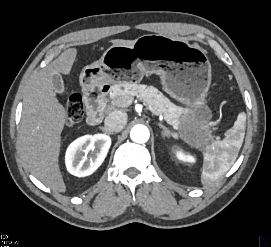 Carcinoma Tail of the Pancreas - CTisus CT Scan